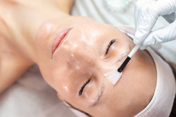 Peelings Químicos: Renovando a Pele de Forma Segura e Eficiente