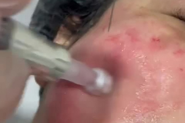Microagulhamento médico em Cuiabá/MT