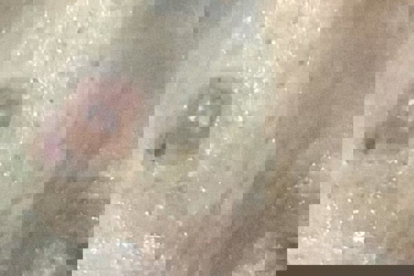 Detecção do Câncer de Pele em Cuiabá/MT
