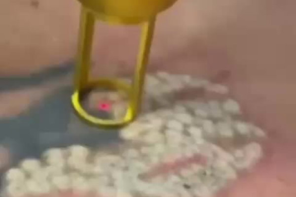 Laser para Remoção de tatuagem  e despigmentação de sobrancelha em Cuiabá/MT