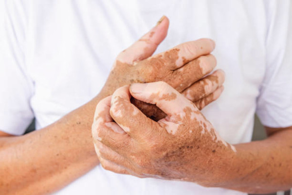 Vitiligo em Cuiabá/MT